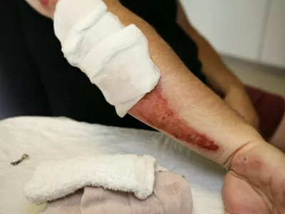 Man with wound on arm